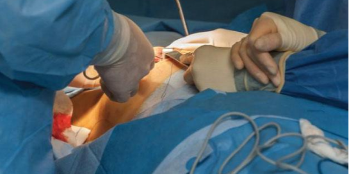 Breast Surgery at Madinah Teaching Hospital, Faisalabad